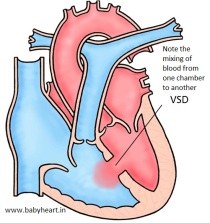 Ventricular-Septal-Defect-Image